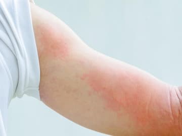 Nesselsucht Geröteter Arm mit Nesselsucht