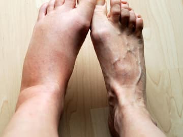 Lymphödem Links: geschwollener Fuß, recht: normaler Fuß