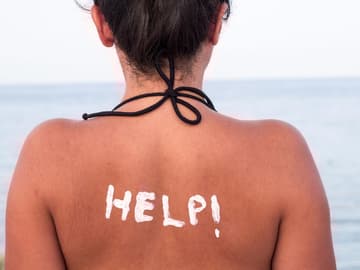 Sonnenbrand Frau mit Sonnenbrand und Sonnencreme auf dem Rücken
