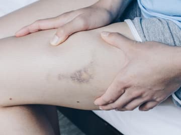 frauen-blaue-flecken