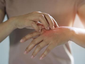Neurodermitis_Hand Frau kratzt sich an geröteter Hand, Neurodermitis