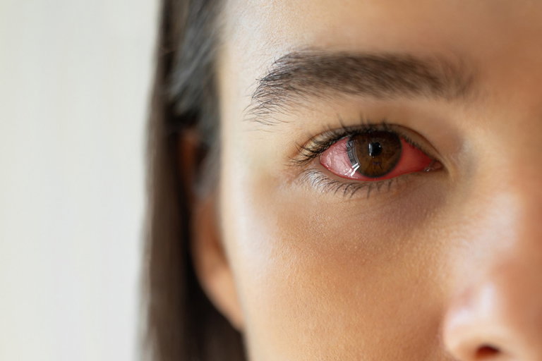 Thrombose im Auge: Ursachen, Symptome, Behandlung