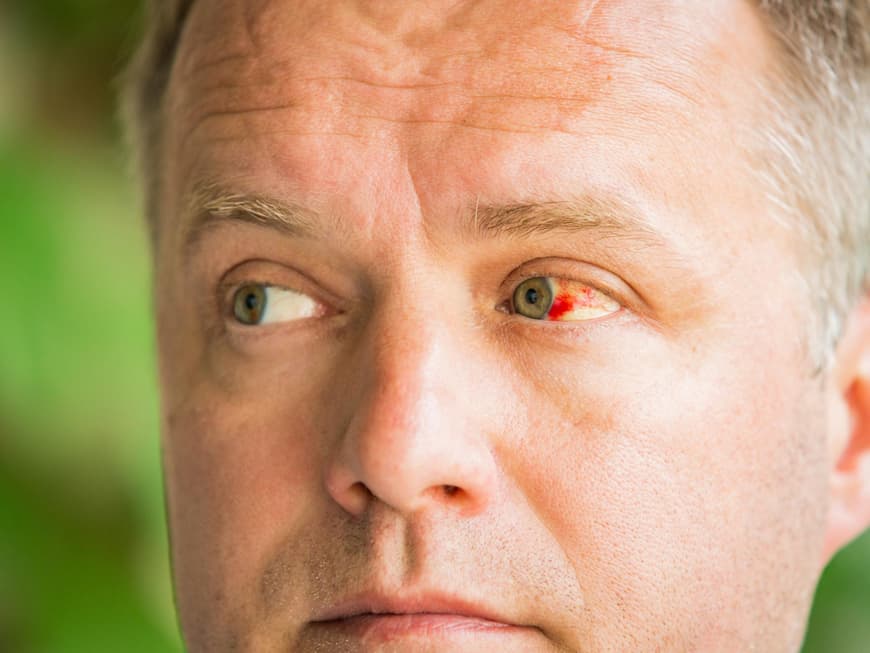 Ader im Auge geplatzt: Das sollten Sie wissen