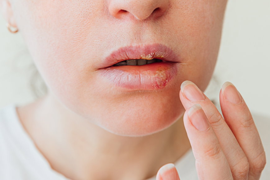 Herpes im Mund: Ursachen und Behandlungen